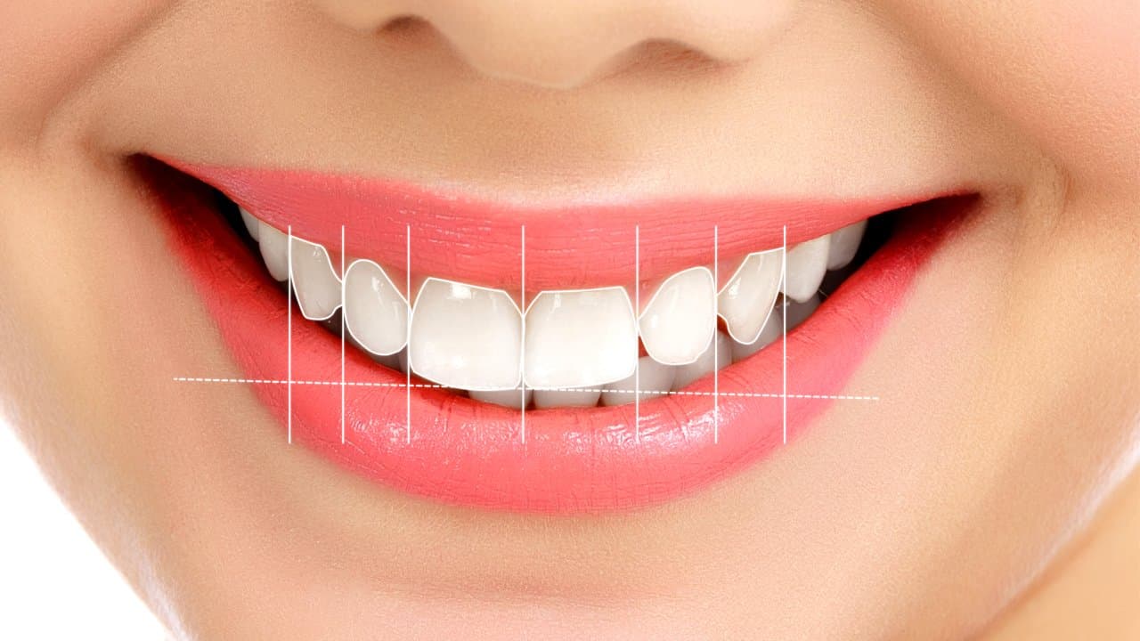 Gülüş Tasarımı (Smile Design): Kimler İçin Uygundur? Aşamaları ve Avantajları